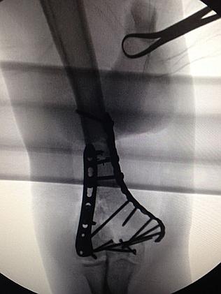 Metal man ... Bono’s X-ray shows his titanium elbow. Picture: Supplied.